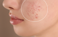 I migliori rimedi per eliminare l'acne